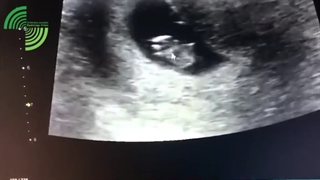 فیلم واقعی سونوگرافی و علت عدم صدای قلب جنین در 3 ماهه بارداری