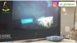 هیستروسکوپی از رحم در iud