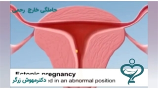 حاملگی خارج از رحمی