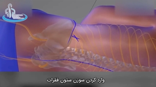 دیسکوگرافی و اندوسکوپی و خارج کردن دیسک پاره شده | متخصص ارتوپد | دکتر محمد ابراهیم طاهریان