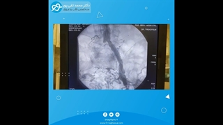 آنژیوپلاستی رگ ایلیاک در آقای مسنی با درد پای راست هنگام راه رفتن