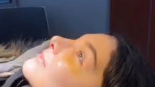 یک هفته پس از جراحی بینی