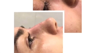 تزریق فیلر بینی