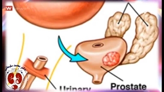 سرطان پروستات - بخش دوم