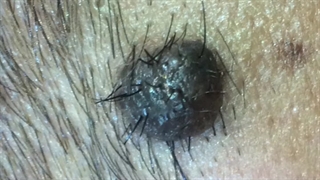 حذف خال درشت