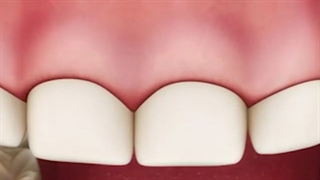 افزایش طول تاج دندان با لیزر | کلینیک تخصصی دندانپزشکی کانسپتا