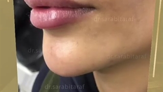 تزریق ژل لب روسی