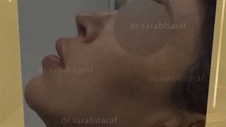 قبل و بعد از زاویه سازی فک دکتر سارا بی طرف