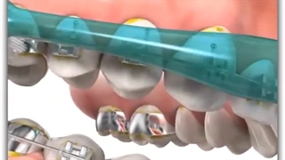 بهداشت دهان در طول ارتودنسی | دکتر سعید قریشی