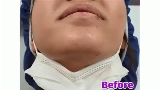 دو هفته پس از عمل بینی