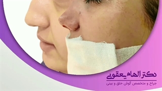 فیلم جراحی بینی بلافاصله بعداز عمل