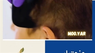 مزوتراپی مو به روایت تصویر