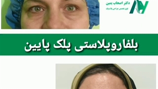 عمل بلفاروپلاستی پلک پایین توسط دکتر اصحاب یمین پر کردن دندان