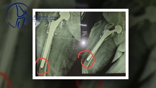 نمونه عمل زانو توسط دکتر پویان علوی نژاد