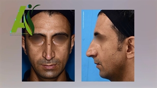 عمل بینی استخوانی - رضایت بیمار