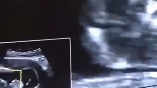 فیلم از سونوگرافى جنین نرمال ١٩ هفته