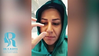 بلفاروپلاستی و جراحی بینی همزمان
