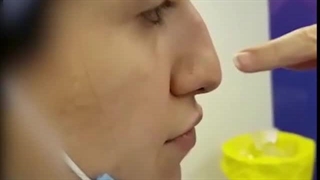 عمل بینی استخوانی- غضروفی