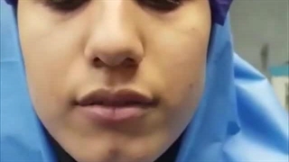 نمای نیم رخ زیباجوی -عمل بینی گوشتی