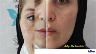 بلفاروپلاستی دکتر مهدیه