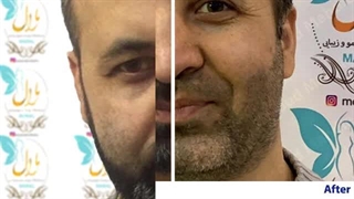جراحی پلک یا بلفاروپلاستی
