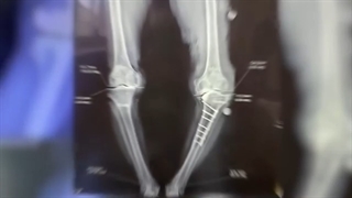 جراحى خانم ٧٥ساله با شکستگى قبلى زانو و انحراف شدید توسط پروتز CKK