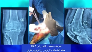 تعویض مفصل کامل زانو در خانم  65 ساله با آرتروز و زانوی پرانتزی