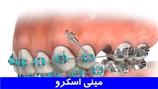 مینی اسکرو | دکتر احسان مهریزی