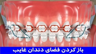 باز کردن فضای دندان غایب | دکتر احسان مهریزی
