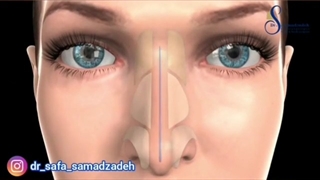 عمل سپتوپلاستی