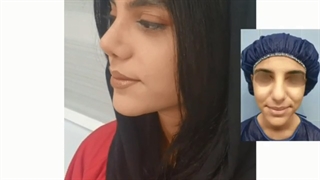 یکماه بعد از جراحی بینی