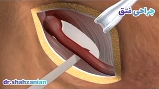 جراحی باز فتق اینگوینال