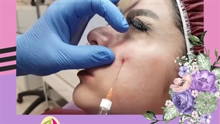 رفع گودی زیر چشم
