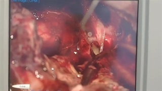 تومور بسیار بزرگ مننژیوم اولفکتوری