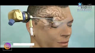 جراحی تومور ساقه مغز