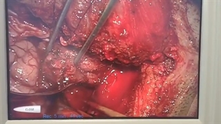 فیلم عمل تومور مغزی