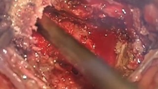 کنسر ریه و متاستاز به مهره های گردن و توراسیک