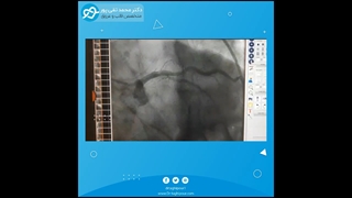 آنژیوپلاستی آقای مسنی با سابقه عمل جراحی قلبی