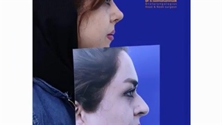 نتیجه جراحی زیبایی بینی