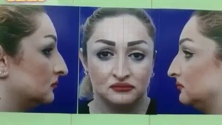 عمل زیبایی بینی