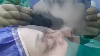 بلافاصله پس از عمل زیبایی بینی