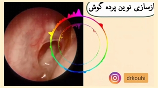 بازسازی پرده گوش