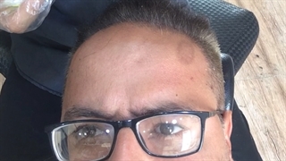 مزونیدلینگ