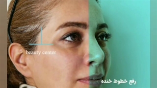فیلم واقعی رفع خطوط خنده با تزریق فیلر