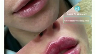 فیلم واقعی تزریق ژل لب روسی