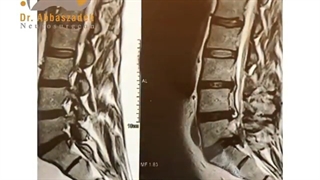 فیلم واقعی جراحی دیسک کمر و بهبودی درد سیاتیکی در آقای جوان