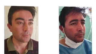 فیلم جراحی لیفت ابرو و شقیقه و بلفاروپلاستی پلک بالا، ۳ ماه پس از عمل