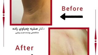 فیلم رفع تیرگی بدن با لیزر