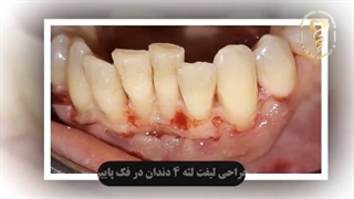 فیلم واقعی جراحی لیفت لثه برای ٤ دندان در فک پایین