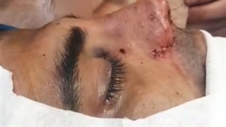 نتیجه جراحی بینی مردانه - پارت 2